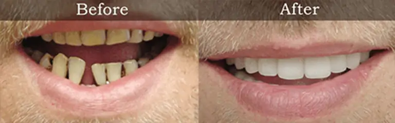Porcelain veneers before and after at Rozenberg Dental NYC - case 1