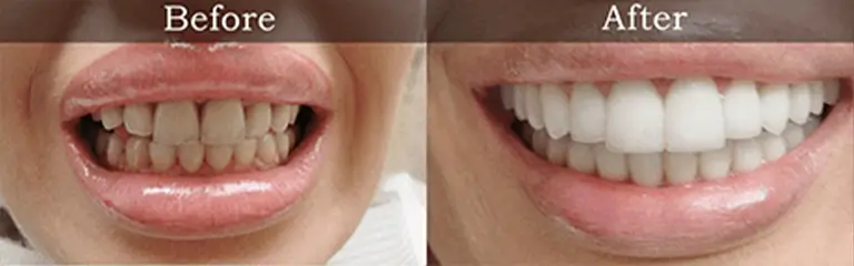 Porcelain veneers before and after at Rozenberg Dental NYC - case 2