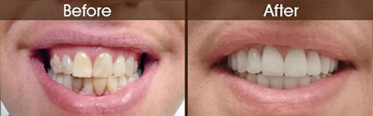 Porcelain veneers before and after at Rozenberg Dental NYC - case 3