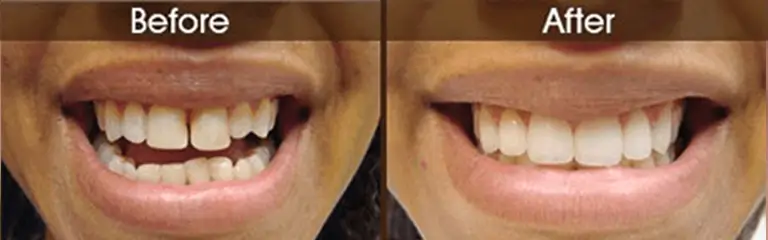 Porcelain veneers before and after at Rozenberg Dental NYC - case 4