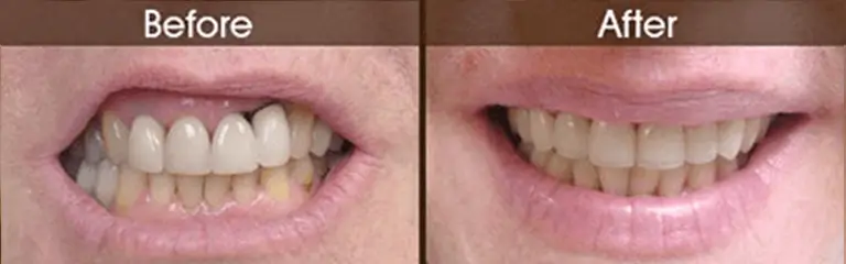 Porcelain veneers before and after at Rozenberg Dental NYC - case 5