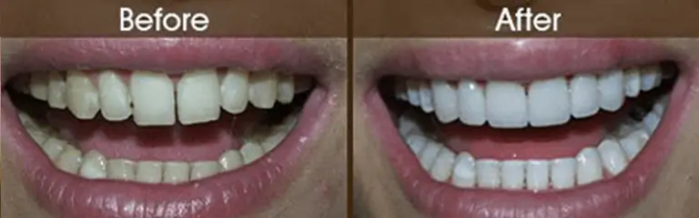 Porcelain veneers before and after at Rozenberg Dental NYC - case 6