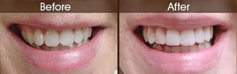 Porcelain veneers before and after at Rozenberg Dental NYC - case 7