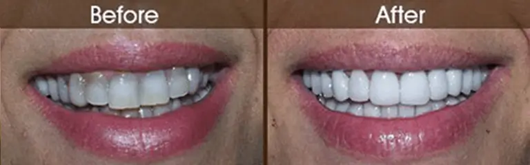 Porcelain veneers before and after at Rozenberg Dental NYC - case 8