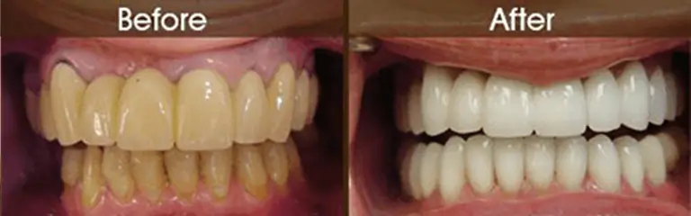 Porcelain veneers before and after at Rozenberg Dental NYC - case 9