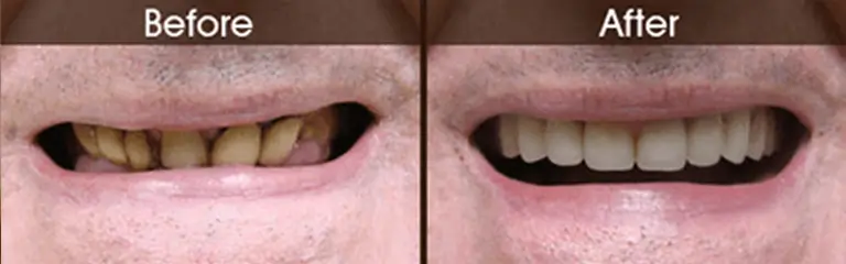 Before and after smile transformation at Rozenberg Dental NYC - case 10