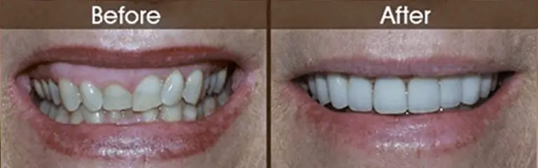 Before and after smile transformation at Rozenberg Dental NYC - case 11