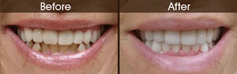 Before and after smile transformation at Rozenberg Dental NYC - case 12