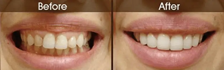 Before and after smile transformation at Rozenberg Dental NYC - case 13