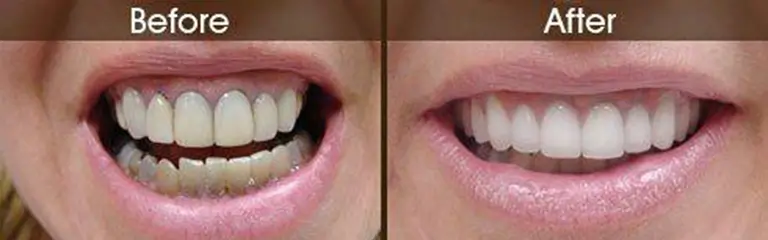Before and after smile transformation at Rozenberg Dental NYC - case 14