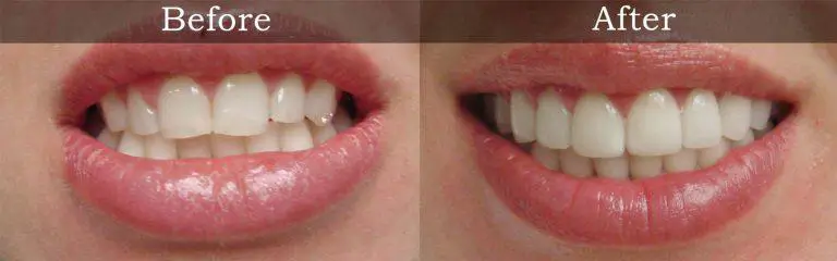 Before and after smile transformation at Rozenberg Dental NYC - case 15