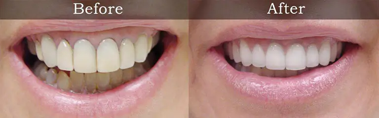 Before and after smile transformation at Rozenberg Dental NYC - case 16