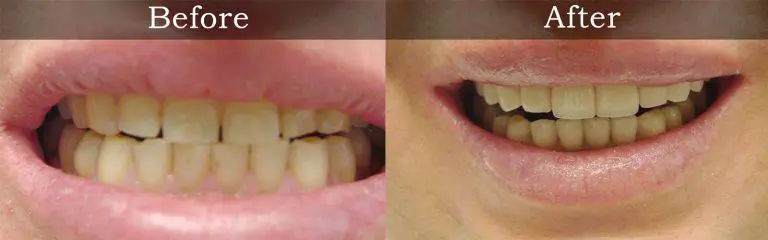 Before and after smile transformation at Rozenberg Dental NYC - case 17