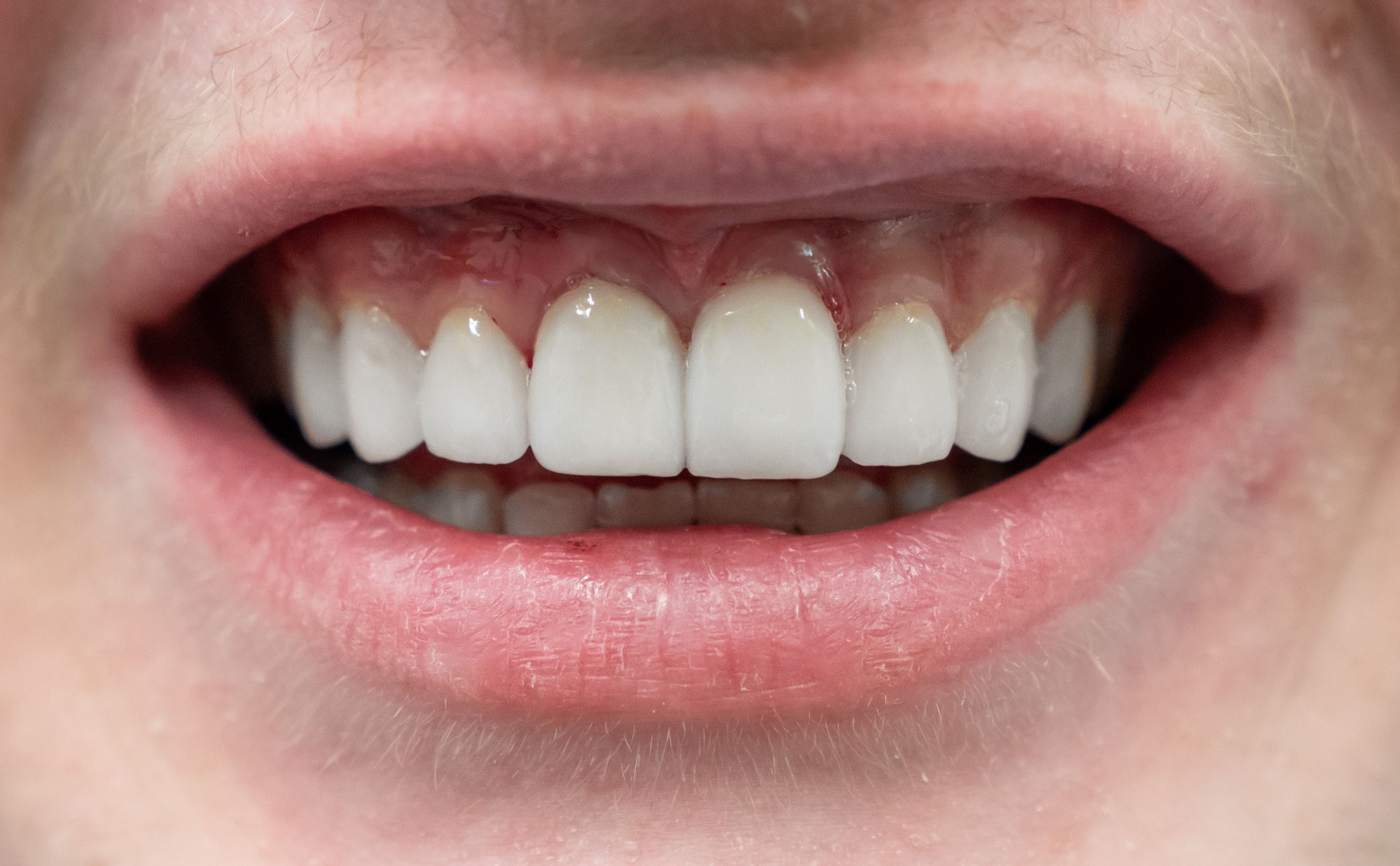 After porcelain veneers at Rozenberg Dental, Midtown NYC