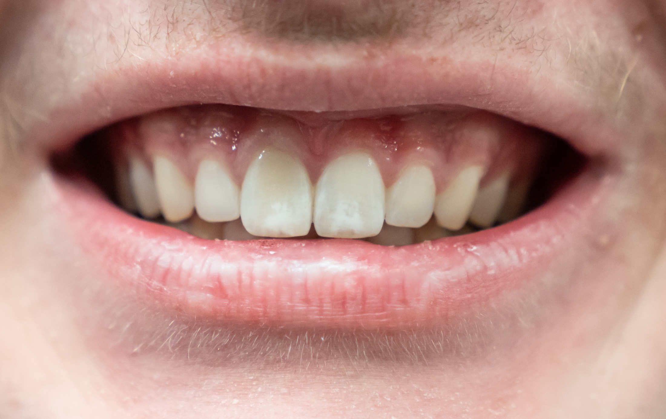 Before porcelain veneers at Rozenberg Dental, Midtown NYC